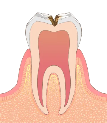 C2: エナメル質が溶け、その中の象牙質まで侵食される